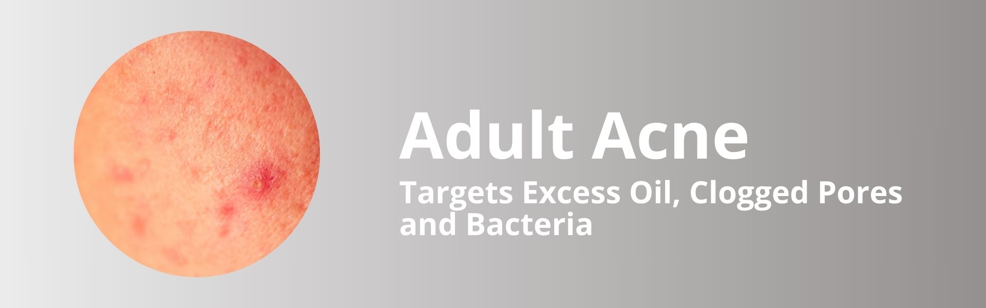 Adult Acne