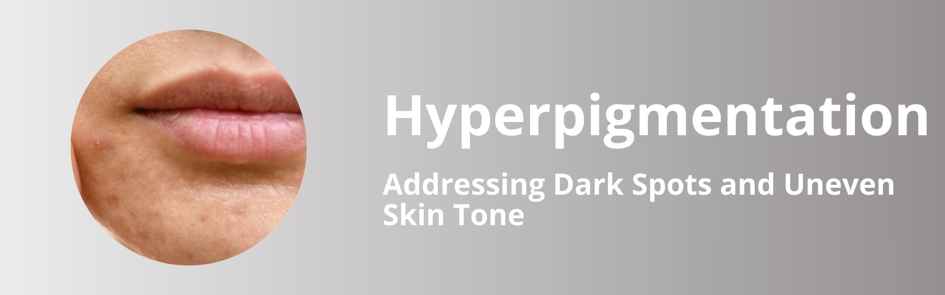 Hyperpigmentation
